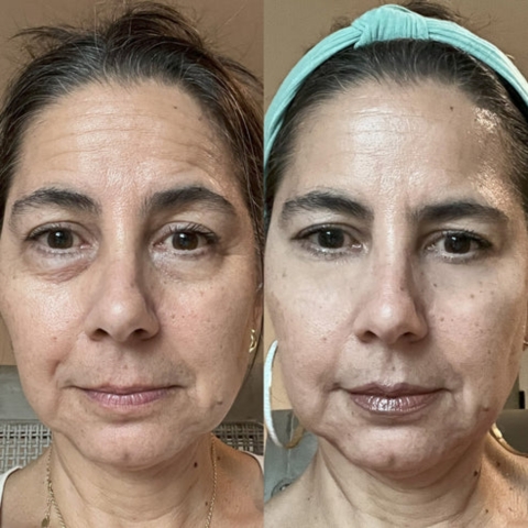 RevitalEyes Under-Eye Red Light Therapy