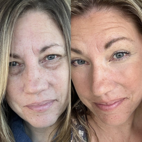 RevitalEyes Under-Eye Red Light Therapy